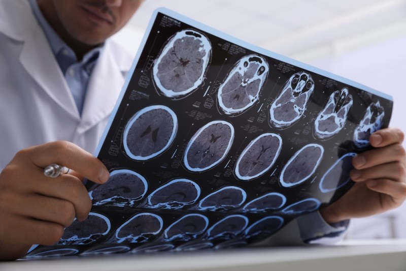 Demența vs Boala Alzheimer: Ce trebuie să știi despre aceste afecțiuni distincte