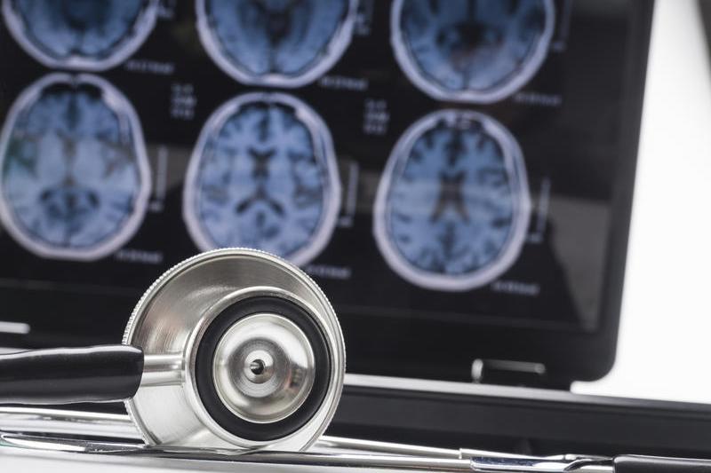 Aprobarea iminentă a unui tratament inovator pentru Alzheimer în Europa: Donanemab