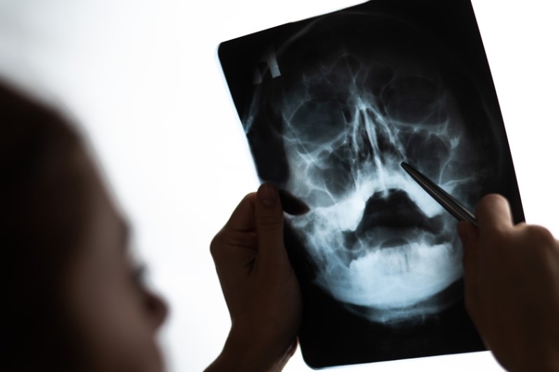 Sinuzita de origine dentară: tratament unic prin colaborarea celor două specialități chirurgicale la Regina Maria Cluj